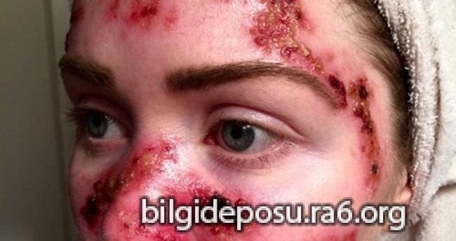 - Bilgideposu Cilt kanseri teşhisi konulduktan sonra başka doktorlara da görünmelisiniz.