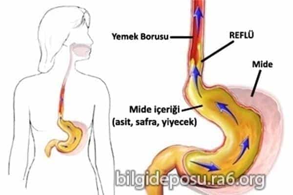 - Bilgideposu Reflü nasıl geçer? Reflü nasıl iyileşir?
