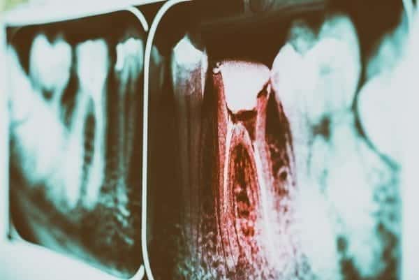 Tooth Decay