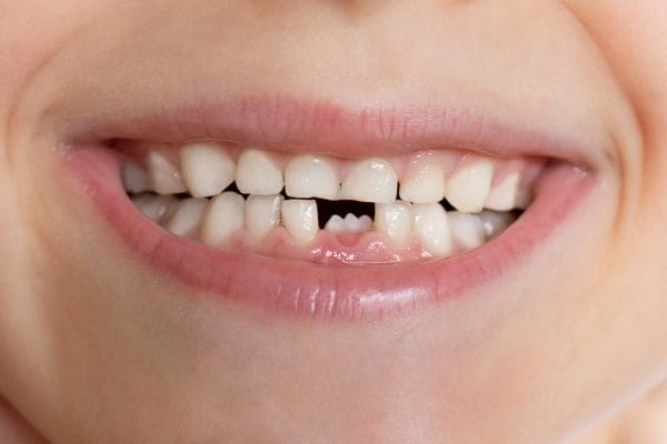 First Tooth Loss