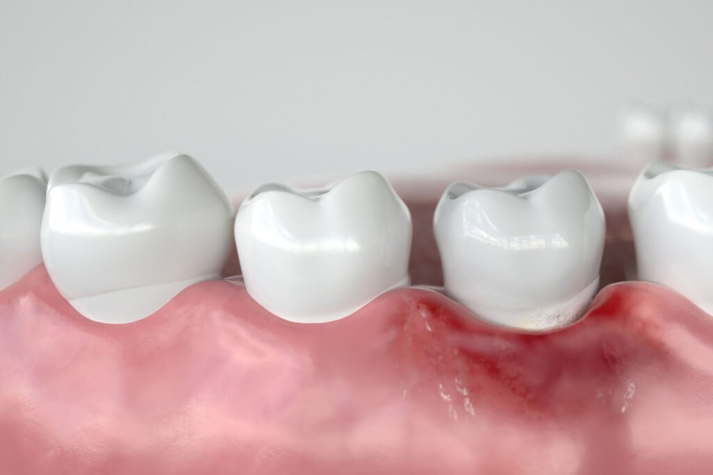 Bodrum diş eti hastalıkları- Bodrum Dişçi