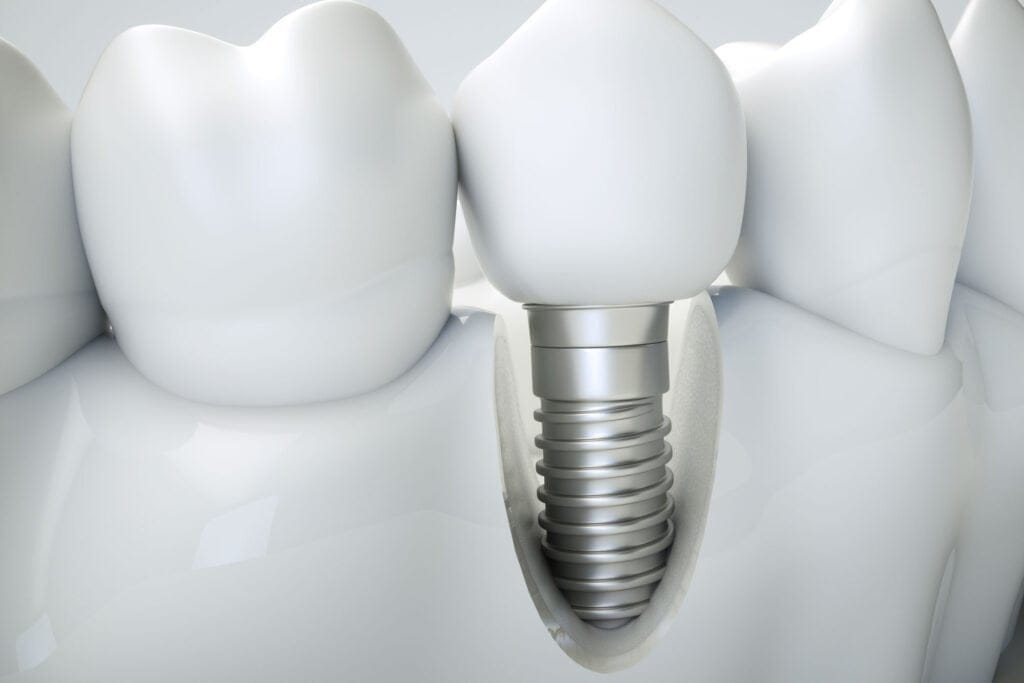 Bodrum Implant Tedavisi