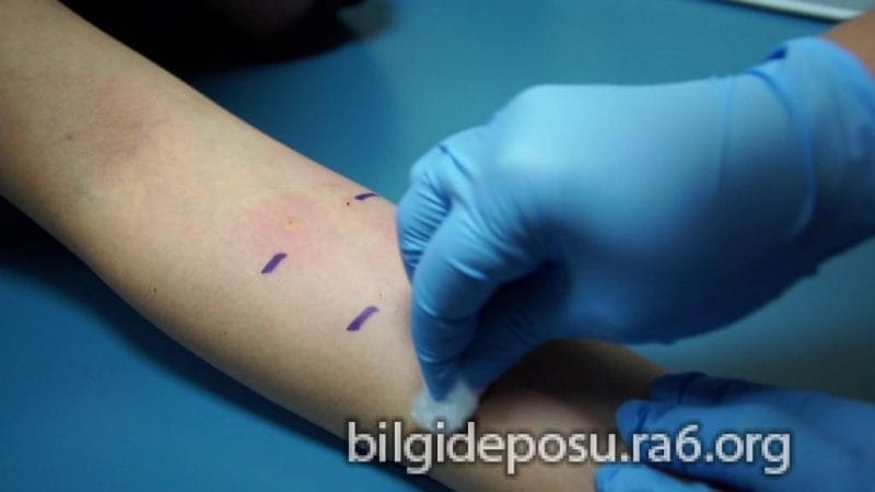 alerji testi - Bilgideposu
