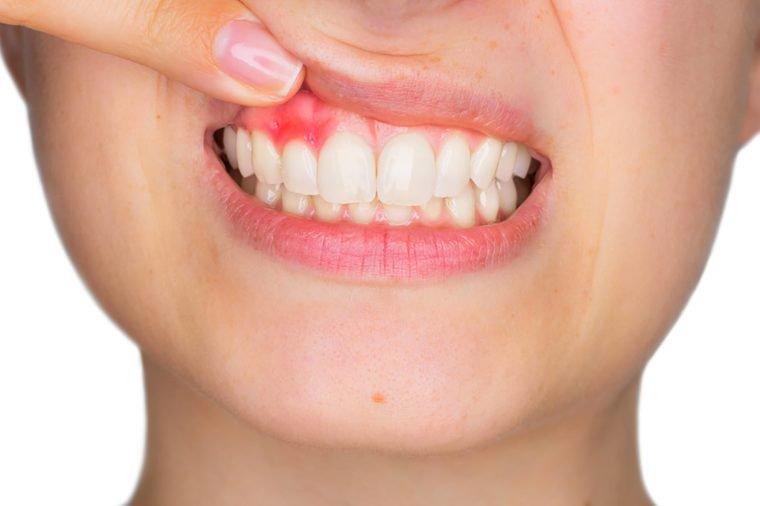 C vitamini nedir? C vitamini nelerde var?