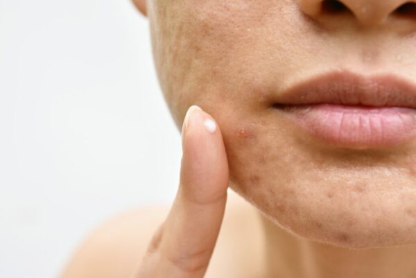 Allergic Reaction to Acne Medication