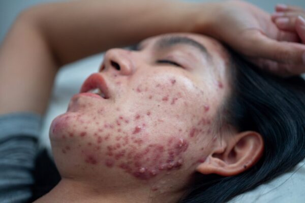 Acne and Allergies