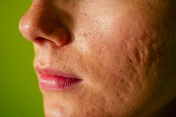 PRP for Acne Scars